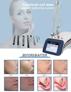 Portable Co2 Laser Dot matrix Machine Professional Laser Women Co2 Machine for Scar Removal - Product Image 6