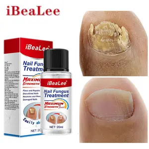 IBeaLee Vente Chaude Efficace Indolore Remède Ongles Anti Bactéries Crème De Traitement Des Champignons Des Ongles - Product Image 1