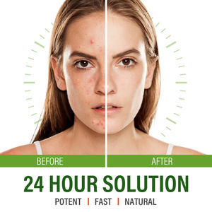 Crème réparatrice pour la peau en marque propre, <span class=keywords><strong>meilleur</strong></span> traitement contre l'acné, crème <span class=keywords><strong>anti</strong></span>-acné, crème pour éliminer les cicatrices d'acné - Product Image 5