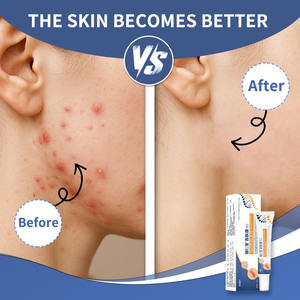 Crème antibactérienne à base de plantes à étiquette privée Mains Pieds Anus Démangeaisons Eczéma Psoriasis Soulagement de la peau Crème <span class=keywords><strong>anti</strong></span>-démangeaisons Prurigineuse - Product Image 4