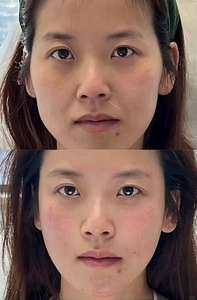 Ácido Hialurónico KXY de Alta Calidad de 1 ml para Reafirmar, Levantar e Hidratar la Piel del Rostro - Product Image 4