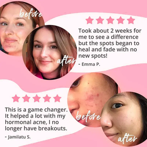 Suplemento Probiótico para el Acné de Marca Privada OEM ODM con Mezcla de 9 Cepas para el Apoyo al Acné - Product Image 4