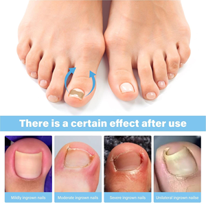 Patch de Correction des Ongles des Pieds, pour Ongles Incarnés et Rainurés, Favorise la Croissance Saine des Ongles, Prévient l'Incarnement, Boîte de Kit de Pédicure Non-tissée - Product Image 4