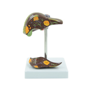 PVC病的肝臓モデルが一般的な肝および胆嚢障害を視覚化 - Product Image 5