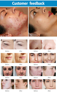 Pulsed CO2 Fractional Laser <strong>Removal</strong> <strong>Cream</strong> with ABS Material for Body <strong>Warts</strong> Condyloma Acuminatum Acne Scars Freckles RF Treatment - Product Image 6