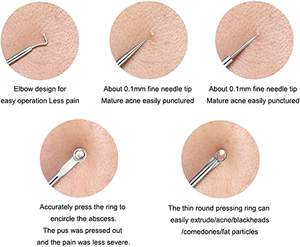 Set di 4 Aghi in Acciaio Inox per la Rimozione di <span class=keywords><strong>Acne</strong></span> e Punti Neri Strumento Pratico per la Pulizia e la Cura della Pelle del Viso - Product Image 5
