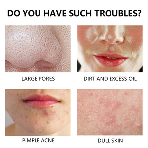 ครีม<span class=keywords><strong>ล้าง</strong></span><span class=keywords><strong>หน้า</strong></span>สูตร<span class=keywords><strong>โฟม</strong></span>สำหรับผิวเป็นสิวง่าย ทำความสะอาดล้ำลึก ปลอดภัย ไม่ระคายเคือง - Product Image 4