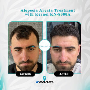 Dispositivo de restauración de cabello LLLT de grado clínico, resultados probados en 12 semanas, dispositivo de tratamiento de <span class=keywords><strong>alopecia</strong></span> androgenética Kernel 2. 2. - Product Image 3