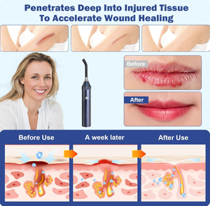 Red Light Therapy Pen 660nm 850nm Infrared Red Blue Purple Massager for <strong>Oral</strong> Cavity Labial <strong>Herpes</strong> Repair at Home - Product Image 1