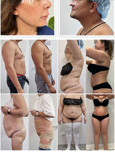 جهاز ليزر تريانجل 2026 الجراحي للرفع بالليزر الثنائي 1470 نانومتر لإزالة الذقن المزدوجة/أكياس العين - Product Image 6