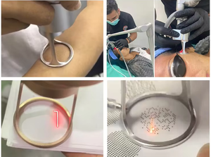 Appareil laser fractionnel CO2 pour l'élimination des cicatrices et le rajeunissement cutané, 10600 nm, usage commercial en salon, prix. - Product Image 4