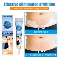 Crème Bio Anti-Taches Blanches Marque Blanche Traitement Localisé du Psoriasis, du Vitiligo, de la Mycose et de la Leucoplasie Raffermissante