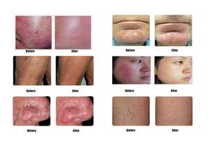 آلة ليزر Milla لسطح المكتب ليزر دايود 980 نانومتر للأوردة الوعائية وريد العنكبوت وعلامات الجلد وإزالة شامة الكرز والشعيرات الدموية - Product Image 6