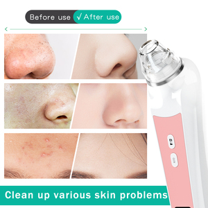 Estrattore di Punti Neri con Fotocamera, Strumento per la Rimozione dei Punti Neri con Aspirazione Ricaricabile USB per Punti Neri e Acne - Product Image 3