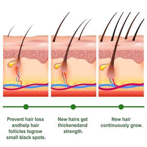 Cápsulas de Suero Capilar Nutritivo de Alta Calidad de Marca Privada, Cápsulas de Aceite <span class=keywords><strong>Esencial</strong></span> para el Cuidado del Cabello con Romero de Alta Calidad - Product Image 5