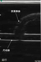 Modelo de estenosis de fístula arteriovenosa guiado por ultrasonido - Membrana de estoma para entrenamiento de dilatación con balón de anastomosis PTA en modo B