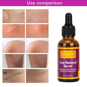 JMFREE logotipo personalizado eliminación de pecas acné <span class=keywords><strong>cicatrices</strong></span> Extracto de hierbas orgánico Anti reparación cicatriz suero quirúrgico eliminación de <span class=keywords><strong>cicatrices</strong></span> - Product Image 2