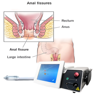 Traitement des hémorroïdes Fistule anale 1470nm Chirurgie des hémorroïdes externes 980nm Rectum Fissure Proclotology Thérapie de traitement - Product Image 1