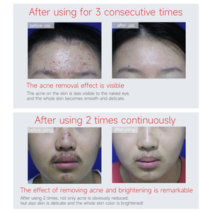 La clinica di bellezza più venduta cinese ha utilizzato la cura della pelle del viso Anti Acne pigmentazione composto soluzione chimica peeling acido glicolico - Product Image 6