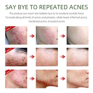 Crème Visage Anti-Acné et Anti-Imperfections à l'Huile d'Arbre à Thé et Centella, Contrôle du Sébum, Marque Privée OEM - Product Image 4