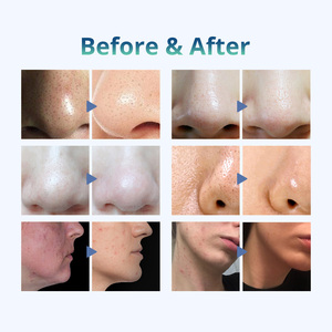 Appareil de beauté portable 6-en-1 pour microdermabrasion, nettoyage du visage et traitement de l'acné par haute fréquence, nettoyage en profondeur - Product Image 6