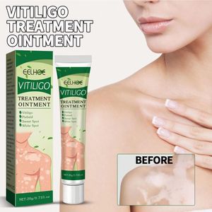 EELHOE Vitiligo Traitement Crème Ointment pour l'élimination des <span class=keywords><strong>taches</strong></span> <span class=keywords><strong>blanches</strong></span>, de la teigne, de la leucoplasie cutanée et de la dermatite 20ml EELHOE Vitiligo - Product Image 4