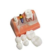 4 Modèles de Couronnes et Ponts Amovibles pour Implants Dentaires, Facettes Dentaires – Ressources Pédagogiques pour l'Enseignement des Sciences Médicales CE/ISO