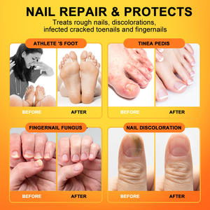 Soin des pieds <span class=keywords><strong>Meilleur</strong></span> <span class=keywords><strong>traitement</strong></span> Remèdes contre les infections fongiques <span class=keywords><strong>Traitement</strong></span> liquide des champignons des ongles des orteils Réparation fongique des ongles - Product Image 3
