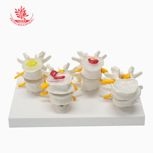El modelo de columna vertebral humana FRT032 utiliza una vértebra lumbar normal y un modelo de lesión de hernia de disco intervertebral lumbar de 4 etapas. - Product Image 2