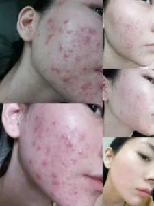 ครีมรักษาสิว<span class=keywords><strong>อักเสบ</strong></span> ลดรอยสิวและสิว<span class=keywords><strong>อักเสบ</strong></span> เซรั่มรักษาสิว<span class=keywords><strong>อักเสบ</strong></span>ที่ดีที่สุด ชุดผลิตภัณฑ์ดูแลผิว 3 ชิ้น - Product Image 3