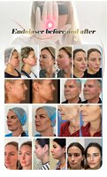Appareil de lifting facial et endo-lifting à fibres optiques Sunrise 635NM 1940NM pour varices, Fibra Radial EVLT