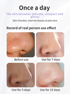 Sản Phẩm Làm Đẹp Trên Khuôn Mặt Sạch Điện Micro Nhỏ Bong Bóng Chu Kỳ Nước Mụn Trứng Cá Lỗ Chân Không Mụn Đầu Đen Loại Bỏ Thiết Bị - Product Image 3