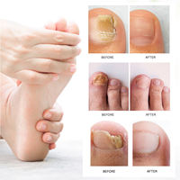Crème Naturelle Pure Contre les Mycoses des Ongles, Gel Réparateur Anti-Infection pour les Ongles des Pieds et des Doigts, Soin de l'Onychomycose, Pommade