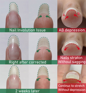 Menghe-kit de pedicura, corrector de uso especial, gel duro uv para manicura y pedicura, producto para uñas encarnadas, nueva fórmula - Product Image 4
