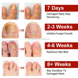 لاصقة SAMVO العشبية لإصلاح وحماية أظافر القدم من الفطريات لمدة 8 ساعات، مصنوعة من مادة الجل، نتائج سريعة وواضحة - Product Image 4