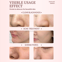 Privé Label AHA+BHA Fruitzuur Anti-Acne Gezichtserum Oplossing Exfolierend Verkleint Porien Verheldert Verlicht Huidverzorging Serum