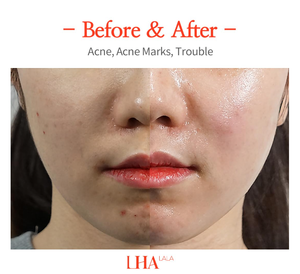 Tratamientos Exfoliantes Lha <span class=keywords><strong>Lala</strong></span> Peel Skincare con Ácido Hidroxi Clínico para Rellenar y Mejorar la Elasticidad de la Piel - Product Image 6