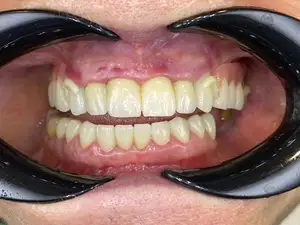 Yu3d 3D Pro çok katmanlı açık sistem lab için önceden gölgeli dental zirkonyum bloklar CADCAM diş seramik blok