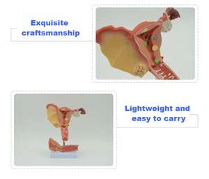 מודל הרחם פתולוגי (2-קטע)-הפאת הפתולוגיה הנשית - Product Image 4