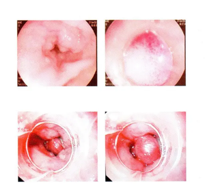 Gastroscopy nội soi phẫu thuật nội soi ban nhạc cao su đa ban nhạc ligator cho thực quản <span class=keywords><strong>varices</strong></span> - Product Image 4