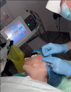 980nm 1470nm Vaser lisolisis Lipo penghilang lemak Pengencang kulit Endolaser Facelift instrumen <span class=keywords><strong>Laser</strong></span> bedah <span class=keywords><strong>Laser</strong></span> sedot lemak - Product Image 3