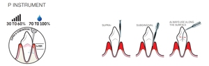 Embout de travail de l'instrument DS-011A EMS P pour l'élimination précise des calculs et des concrétions sous-gingivaux et supragingivaux tenaces - Product Image 4