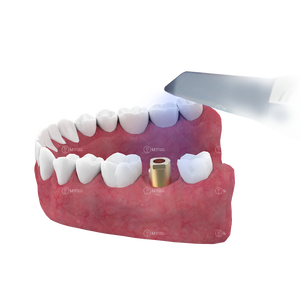 M6 Biomet 3i Pilier de numérisation dentaire en titane <span class=keywords><strong>compatible</strong></span> avec certains <span class=keywords><strong>implants</strong></span> - Product Image 3
