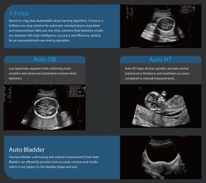 Sonoscape P11Elite <span class=keywords><strong>4D</strong></span>/5D Trolley Machine à ultrasons Doppler couleur avec sonde convexe électrique pour veines bébé abdomen - Product Image 4
