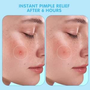 Caja de Espejo OEM con Etiqueta Privada, Parches Hidrocoloides para Acné, Parches para Granos y Manchas - Product Image 2