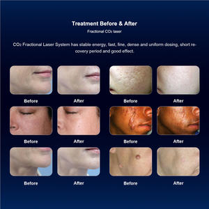 Appareil laser fractionné au CO2 ApexScan 10600nm pour le resserrement vaginal, le traitement de l'acné, le rajeunissement de la peau, usage domestique et commercial, certifié CE - Product Image 3