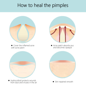 Oem 18 chấm sao và hình trái tim màu xanh màu mụn vá Hydrocolloid dễ thương mụn vá điều trị nhược điểm - Product Image 2