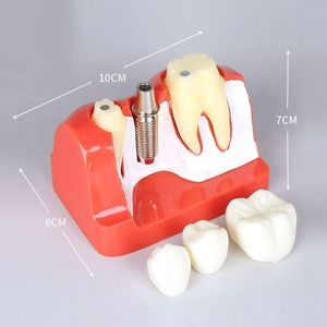 Modèle d'implant dentaire Dt M2017R, modèle anatomique en silicone médical pour l'enseignement des sciences médicales - Product Image 2