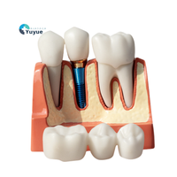 Modèle Anatomique Détachable en Résine pour Prothèses Dentaires et Implants – Usage Hospitalier, Universitaire et Médical – YUYUE