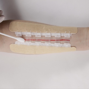 Dispositif de fermeture de plaie à fermeture éclair médicale pour les urgences - Product Image 2